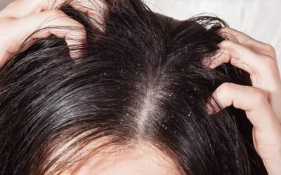 50% de la población mundial sufre de caspa