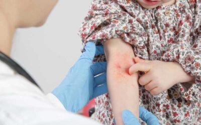 10% de los adultos y 20% de los niños en el mundo tienen dermatitis atópica