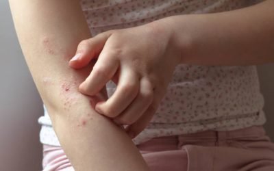 Más de 3 millones de adolescentes pueden tener dermatitis atópica en Colombia