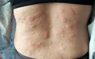 Urticaria Crónica Espontánea: afección que impacta mucho más que la piel